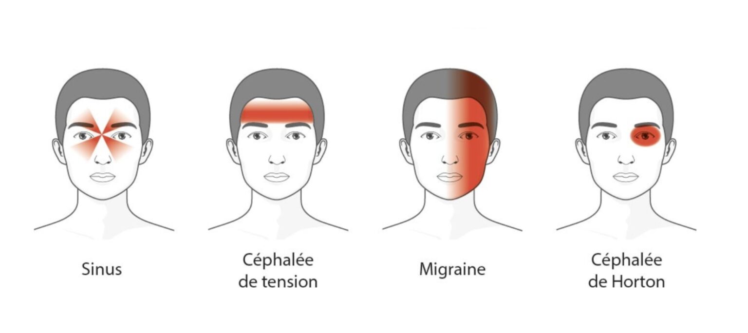 Illustration montrant les différentes localisations des céphalées sur le visage d’un homme, avec des zones mises en évidence.